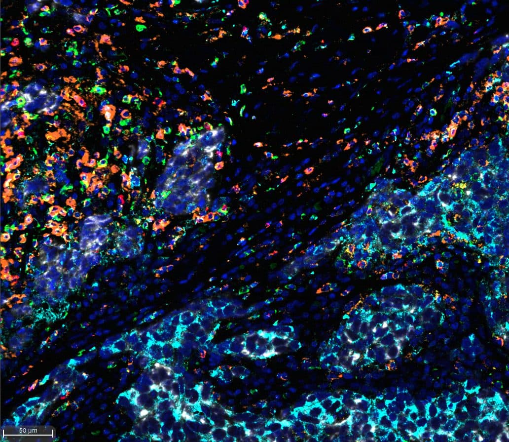 Multiplex immunofluorescence: tumor microenvironment